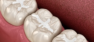 3D illustration of tooth-colored fillings