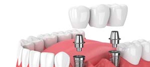 two dental implants holding a bridge 