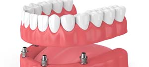 four dental implants holding a denture 