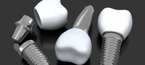 three dental implants with crowns and abutments 
