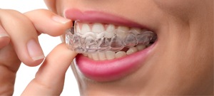 Woman putting in a clear aligner tray 