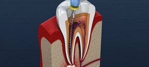 diagram of root canal