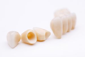 dental crowns and bridge